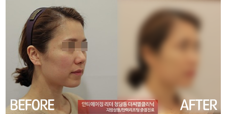 실루엣리프팅