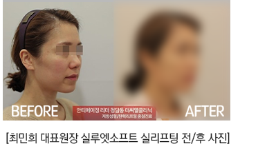 실루엣리프팅