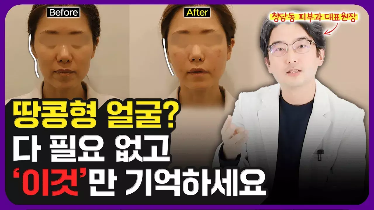 땅콩형 얼굴 '이 방법'으로 매끈해집니다(볼꺼짐, 볼패임)