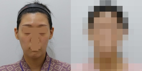 풀페이스 지방이식 1차 시술 9일 후