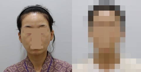 풀페이스 지방이식 1차 시술 1주일 후 전후사진입니다. 