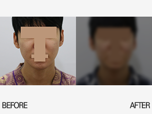 얼굴지방흡입