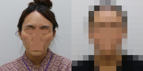 관자, 윗눈꺼풀꺼짐, 볼살 지방이식 1차 시술 직후 전후사진입니다. 