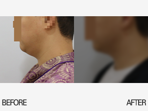 얼굴지방흡입