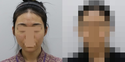 풀페이스 지방이식 2차 시술 1주일 후 전후사진